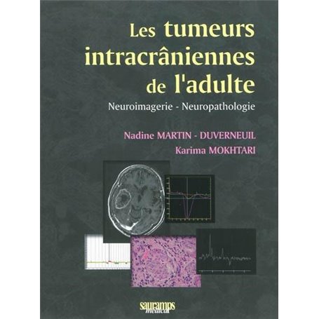 LES TUMEURS INTRACRANIENNES DE L ADULTE