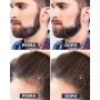 ZEXIJOW Rouleau pour la pousse de la barbe,540 aiguilles en titane de 0,5 Mm,Rouleau Derma pour hommes,Stimuler la croissance de