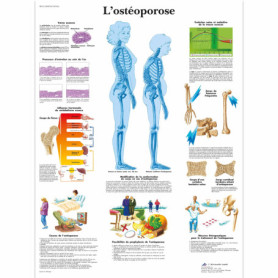 Planche Anatomique Plastifiée sur l'Ostéoporose - 3B Scientific